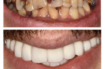 Причини та лікування запаху з рота після видалення аденоїдів