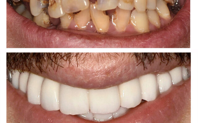 Причини та лікування запаху з рота після видалення аденоїдів