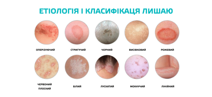 Причини виникнення лишаю: основні джерела і фактори ризику