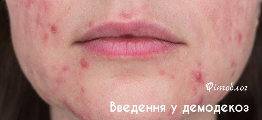 Причини виникнення підшкірного кліща у людей: основні фактори