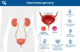 Причини виникнення циститу: основні фактори та як їх уникнути