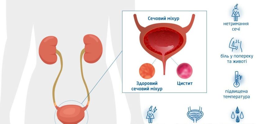 Причини виникнення циститу: основні фактори та як їх уникнути