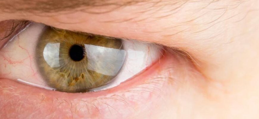 Птоз після ботоксу: причини, симптоми та способи відновлення