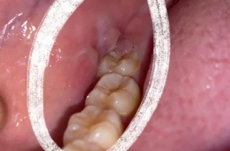 Пульсуючий біль після видалення зуба: причини та методи полегшення