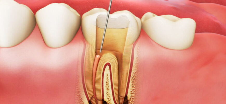 Пульсуючий біль після видалення зуба: причини та способи полегшення