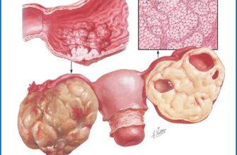 Раціон харчування після видалення поліпа зі шлунка: поради та рекомендації