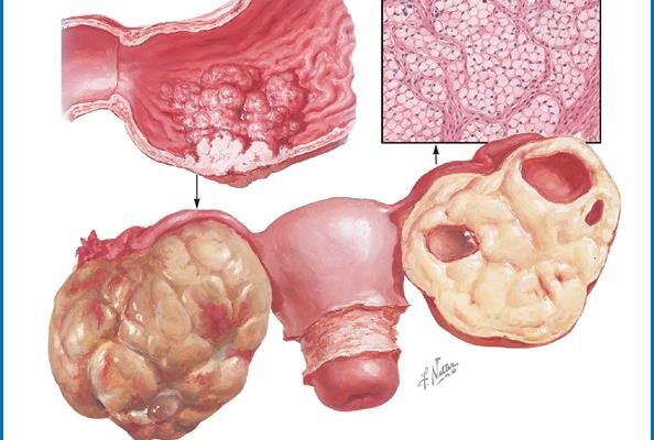 Раціон харчування після видалення поліпа зі шлунка: поради та рекомендації