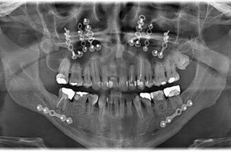 Реабілітація після видалення кісти зуба: поради для швидкого відновлення