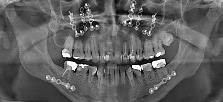 Реабілітація після видалення кісти зуба: поради для швидкого відновлення