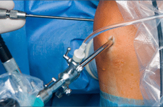 Реабілітація після видалення меніска: поради та методи відновлення