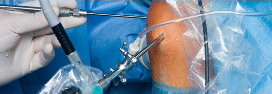 Реабілітація після видалення меніска: поради та методи відновлення