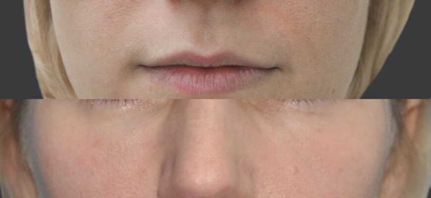 Рекомендації з догляду за губами після процедури їх збільшення