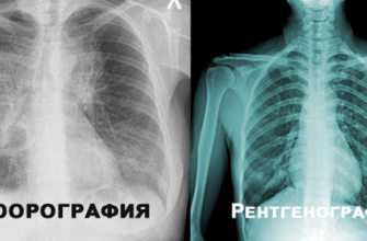 Рентген vs Флюорографія: Основні Відмінності та Особливості Діагностики