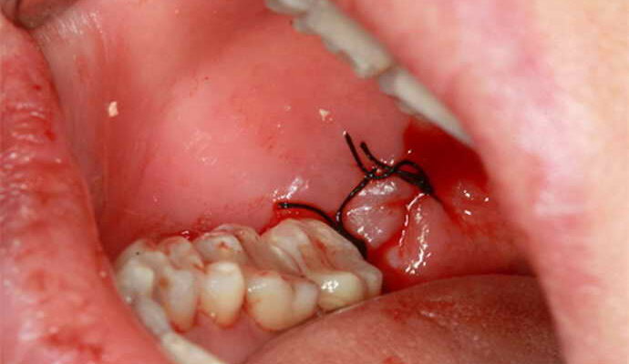 Розійшлися шви після видалення зуба: причини, наслідки, дії