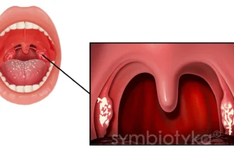 Що їсти після видалення гланд: безпечна дієта для швидкого відновлення