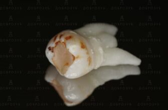 Що категорично не можна вживати після видалення зуба мудрості?