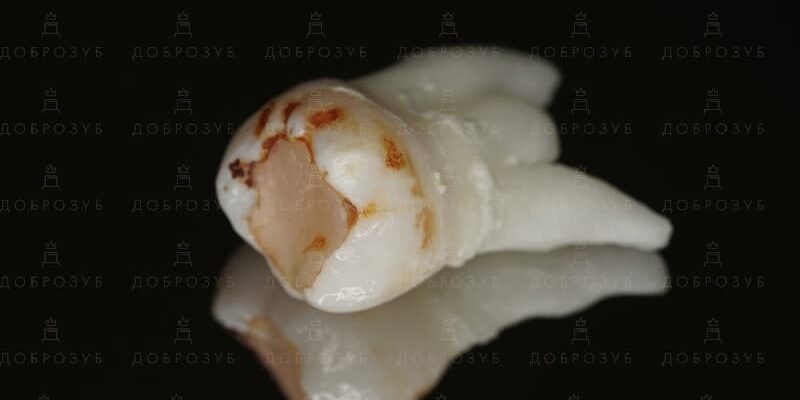 Що категорично не можна вживати після видалення зуба мудрості?