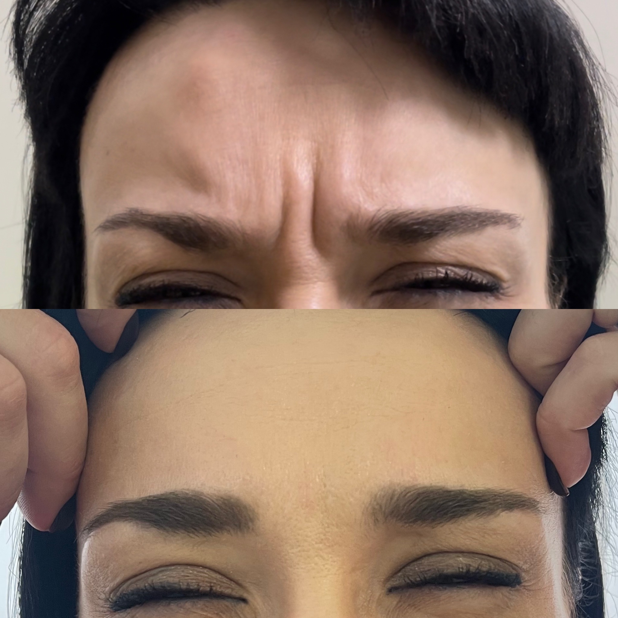 Ін'єкції ботокса в Івано-Франківську: ціна – корекція зморшок