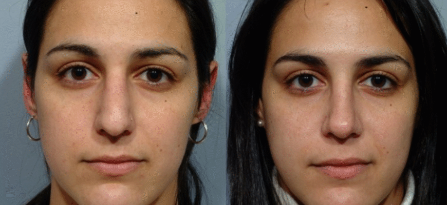 Що категорично заборонено робити після септопластики: основні застереження