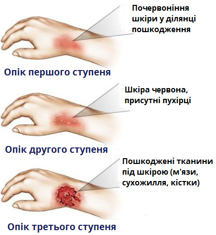 Що відбувається зі шкірою під час опіку - Настільні книги