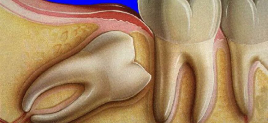 Що робити, коли опухла щока після видалення зуба: поради та лікування