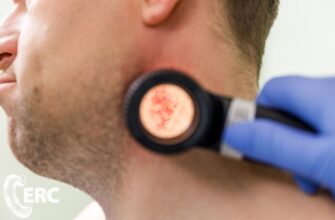 Що робити після видалення базаліоми: поради для швидкого відновлення