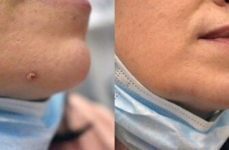 Що робити після видалення селезінки: поради для швидкого відновлення