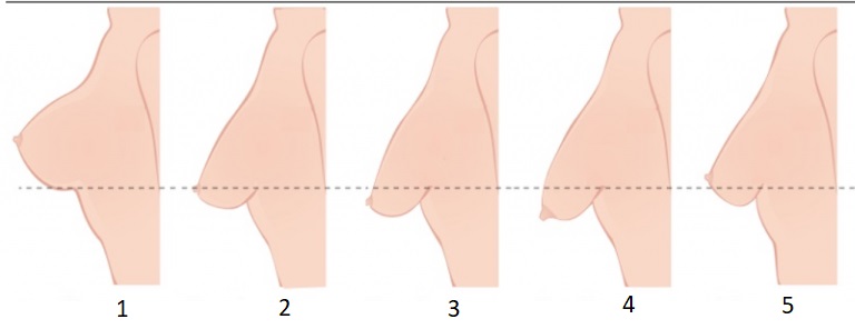 Підтяжка грудей після пологів | Пластичний хірург Федорук