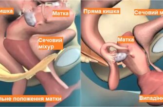 Що таке спайки після операції: причини, симптоми та лікування