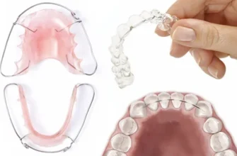 Що встановлюють після брекетів: особливості ретейнерів та елайнерів