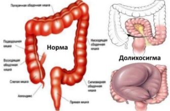 Що викликає біль у сигмоподібній кишці: причини та лікування