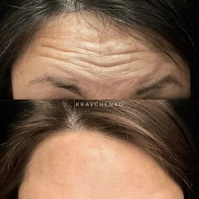 Що заборонено робити після ботоксу лоба: важливі рекомендації