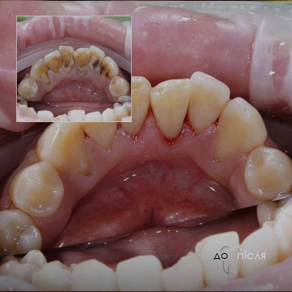 Професійна чистка зубів у стоматології – чи потрібно і як часто?