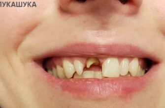 Що заборонено робити після встановлення зубної коронки: основні поради