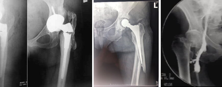 Що заборонено робити після заміни кульшового суглоба: ключові поради