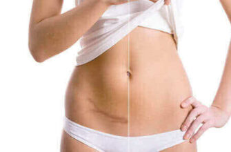 Шов після кесаревого розтину: догляд, відновлення, уникнення ускладнень