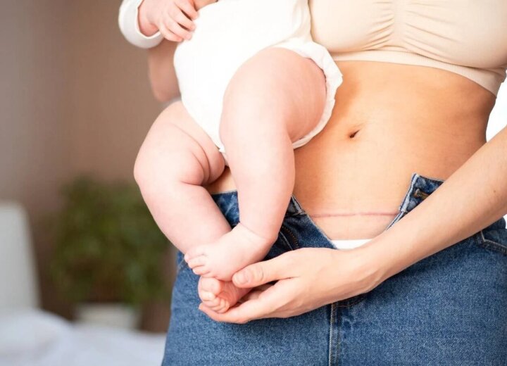 Як доглядати за швом після кесаревого розтину — блог медичного ...