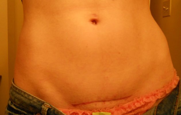 Шрам від кесаревого розтину – небажаний наслідок чи слід на пам'ять?