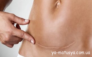 Шви після пологів: догляд, загоєння та корисні поради для мам