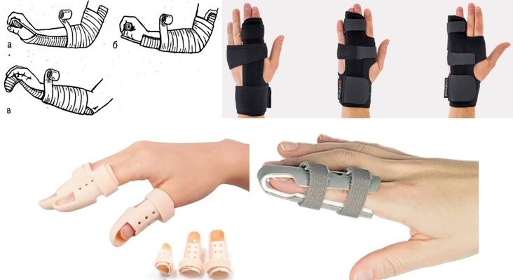 Скільки часу болітиме рука після перелому: що очікувати та як діяти