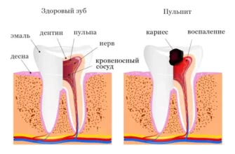 Скільки часу може боліти зуб після пломбування: що очікувати?