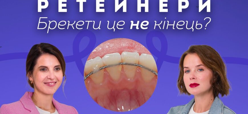 Скільки часу необхідно носити капу після зняття брекетів?