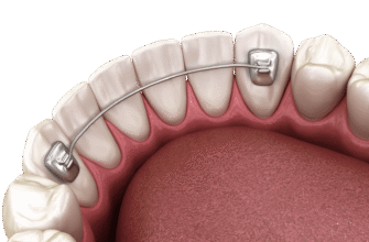 Скільки часу необхідно носити ретейнери після зняття брекетів?