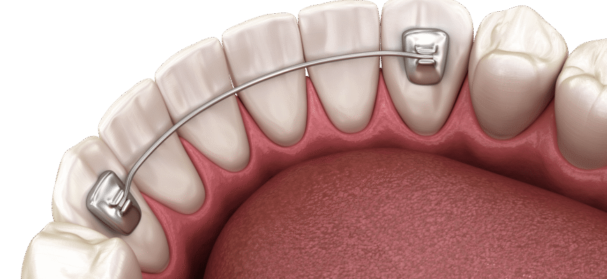 Скільки часу необхідно носити ретейнери після зняття брекетів?