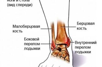 Скільки часу нога може боліти після перелому: основні етапи відновлення