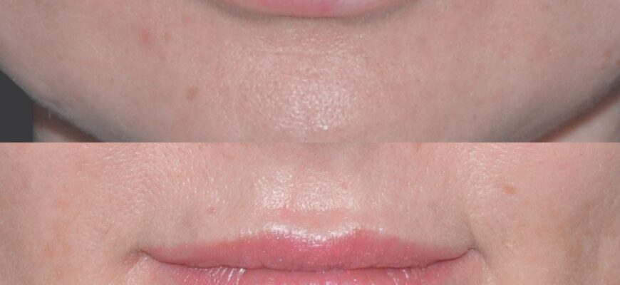 Скільки часу потрібно для загоєння губ після збільшення?