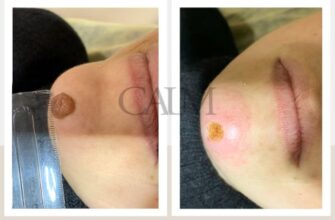 Скільки часу потрібно для загоєння рани після видалення родимки?