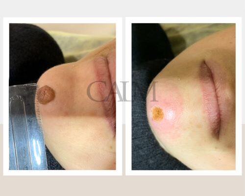 Скільки часу потрібно для загоєння рани після видалення родимки?