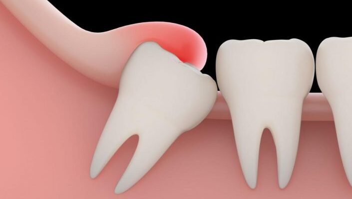 Скільки часу потрібно для загоєння рани після видалення зуба?