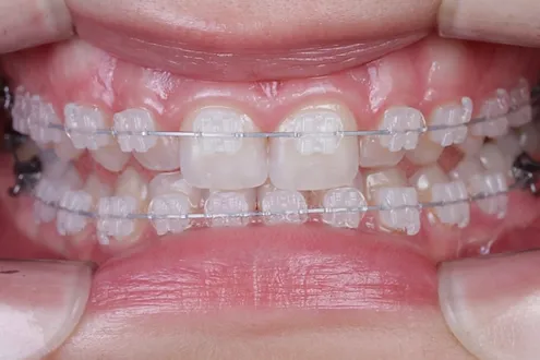 Брекети в Одесі - ціни на встановлення брекет-систем у ...